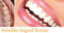 invisalign lingual braces