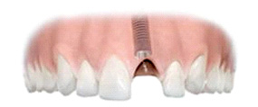 The dental implant is installed in the jawbone. No healthy teeth are affected or damaged. With other replacement solutions, adjacent teeth might need to be ground down to support a bridge.