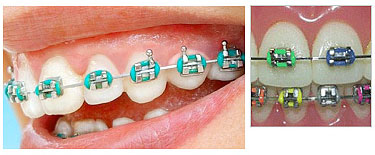 Traditional braces made of high grade stainless steel