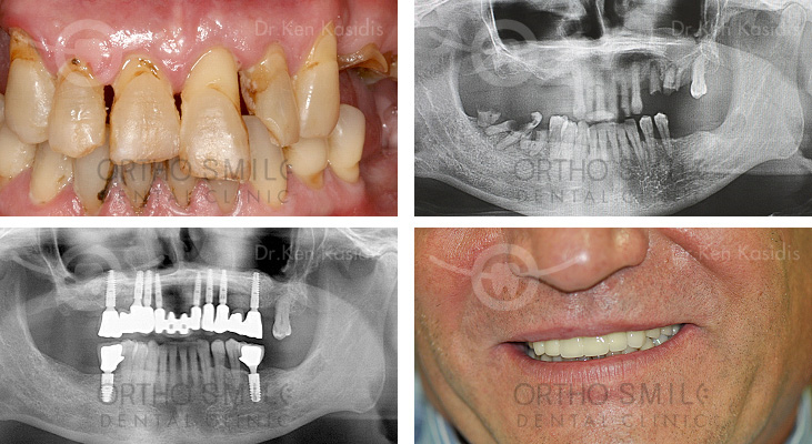 Full Mouth Rehabilitation with Dental Implants